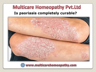 Is psoriasis completely curable?