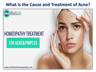 What is the Cause and Treatment of Acne?