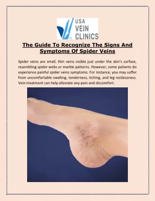 The Guide To Recognize The Signs And Symptoms Of Spider Veins
