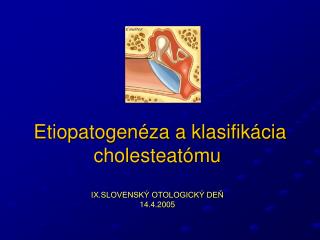 Etiopatogenéza a klasifikácia cholesteatómu IX.SLOVENSKÝ OTOLOGICKÝ DEŇ 14.4.2005