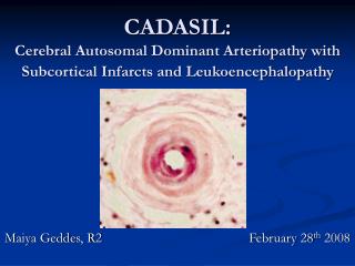 CADASIL: Cerebral Autosomal Dominant Arteriopathy with Subcortical Infarcts and Leukoencephalopathy