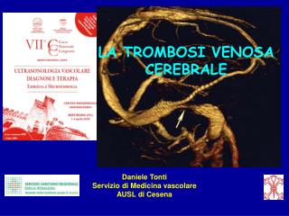 Dieta a thrombophlebitis delle estremità più basse