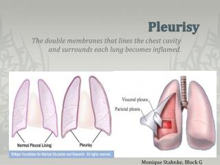 pleurisy lung dry chest ppt powerpoint presentation inflamed becomes surrounds membranes stahnke cavity monique symptoms lines block double each