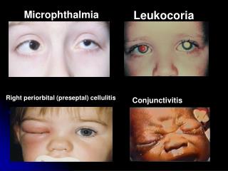 leukocoria microphthalmia infantile ppt powerpoint presentation cellulitis cataracts conjunctivitis preseptal periorbital opacity lens called eye any right