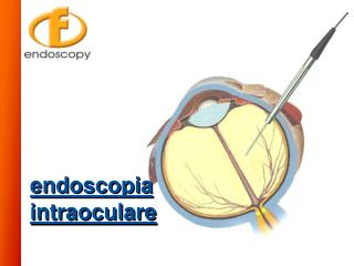 endoscopia intraoculare