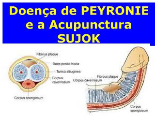 Doença de PEYRONIE e a Acupunctura SUJOK