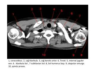 1, sağ atrium . 2, Aort kökü. 3, pulmoner çıkış yolu. 4, sol atriyum . 5, Göğüs inen aorta.