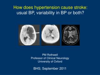 How does hypertension cause stroke: usual BP, variability in BP or both?
