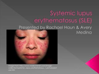 Systemic lupus erythematosus (SLE)