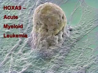 HOXA9 – Acute Myeloid Leukemia