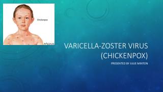 VARicella - zoster virus (chickenpox)