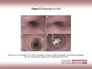 Figure 2 Endoscopy for EoE