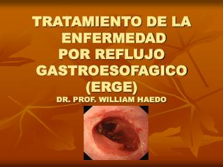 TRATAMIENTO DE LA ENFERMEDAD POR REFLUJO GASTROESOFAGICO (ERGE) DR. PROF. WILLIAM HAEDO