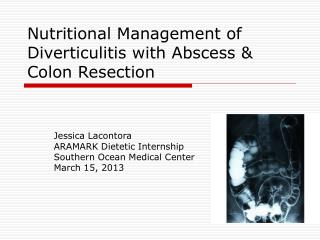 Nutritional Management of Diverticulitis with Abscess &amp; Colon Resection