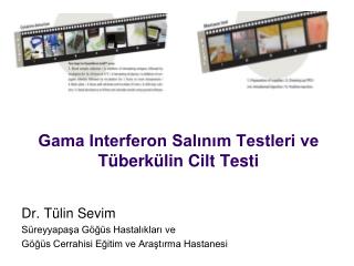 Gama Interferon Salınım Testleri ve Tüberkülin Cilt Testi