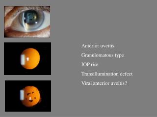 Anterior uveitis Granulomatous type IOP rise Transillumination defect Viral anterior uveitis?