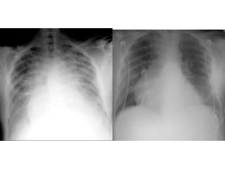 D.D of Unilaterally Opacified Lung