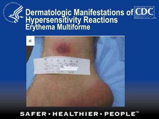 Dermatologic Manifestations of Hypersensitivity Reactions Erythema Multiforme