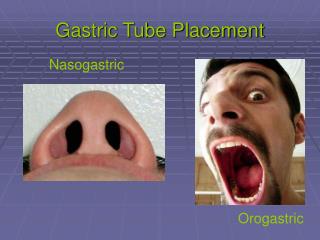 Gastric Tube Placement