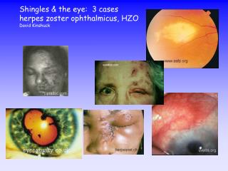 Shingles &amp; the eye: 3 cases herpes zoster ophthalmicus, HZO David Kinshuck