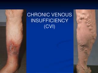 CHRONIC VENOUS INSUFFICIENCY (CVI)