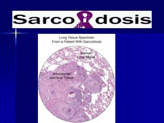 What Is Sarcoidosis ?