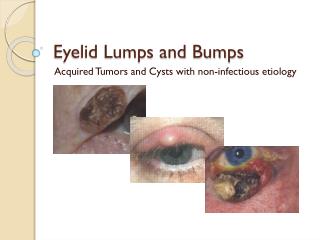 Eyelid Lumps and Bumps