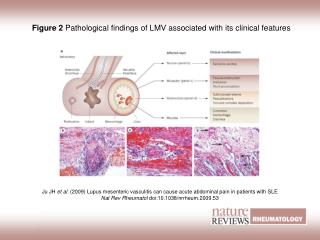 Figure 2 Pathological findings of LMV associated with its clinical features