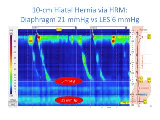10-cm Hiatal Hernia via HRM: Diaphragm 21 mmHg vs LES 6 mmHg