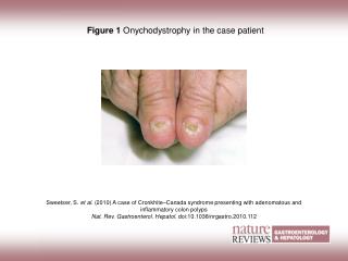 Figure 1 Onychodystrophy in the case patient