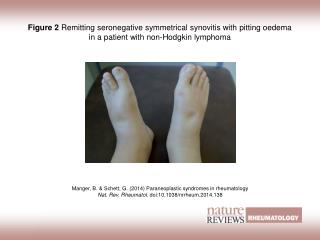 Figure 2 Remitting seronegative symmetrical synovitis with pitting oedema