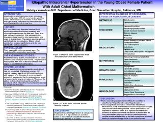 Idiopathic Intracranial Hypertension in the Young Obese Female Patient
