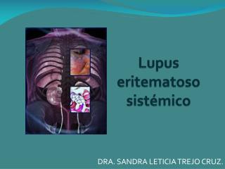 Lupus eritematoso sistémico