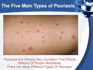 The Five Main Types of Psoriasis