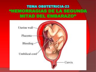 TEMA OBSTETRICIA-23 “HEMORRAGIAS DE LA SEGUNDA MITAD DEL EMBARAZO”