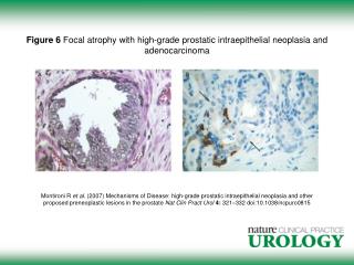 Figure 6 Focal atrophy with high-grade prostatic intraepithelial neoplasia and adenocarcinoma