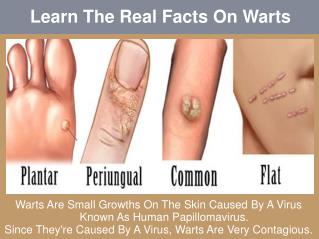 Learn The Real Facts On Warts