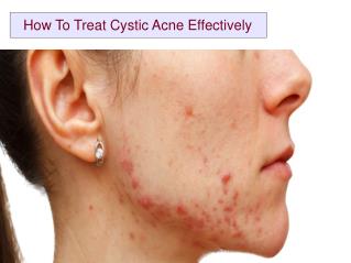 How To Treat Cystic Acne Effectively