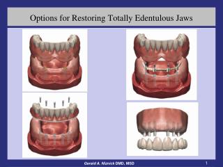 Options for Restoring Totally Edentulous Jaws