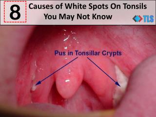 8 Causes of White Spots On Tonsils You May Not Know