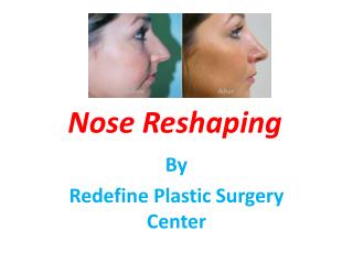Nose Reshaping Surgery in hyderabad