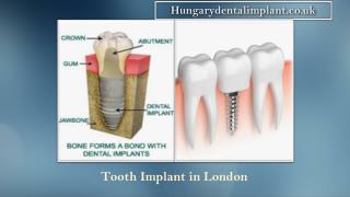 Tooth Implant In London and Budapest