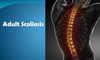 Adult scoliosis - What You Need to Know