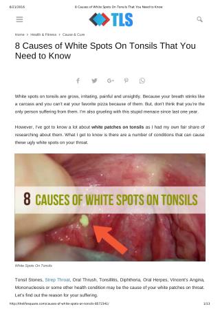 8 Causes of White Spots On Tonsils You May Not Know