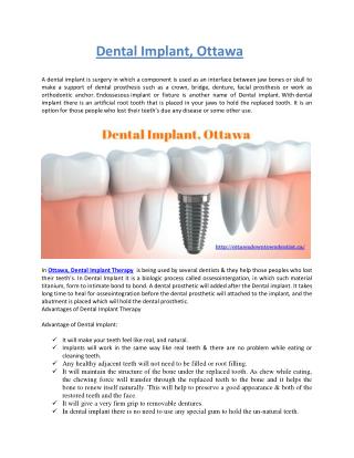 Dental Implant, Ottawa