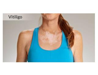 Vitilgo Tratamiento Para El Vitiligo, Tratamiento Para Vitiligo, Vitiligo Es Contagioso, Vitiligo