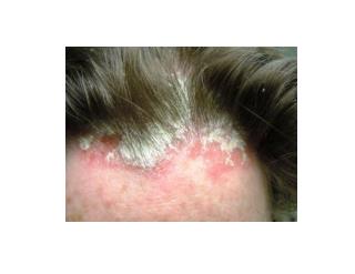 Is Psoriasis Contagious, Treatment For Scalp Psoriasis, Over The Counter Psoriasis Treatment