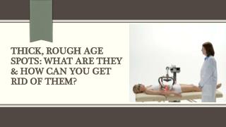 Thick, Rough Age Spots What Are They & How Can You Get Rid of Them?