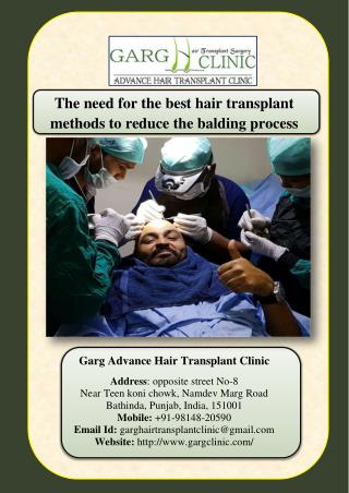 The need for the best hair transplant methods to reduce the balding process