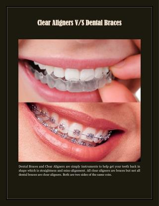 Clear Aligners V/S Dental Braces